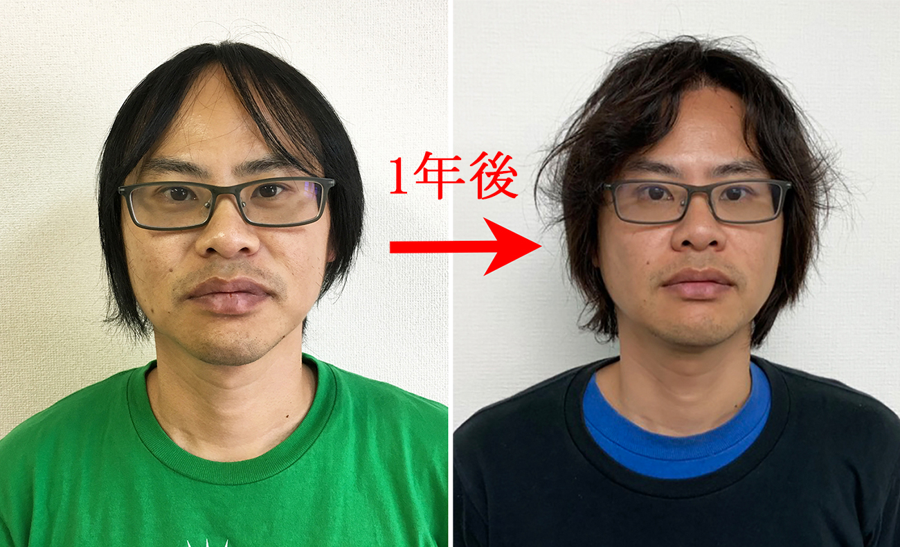 ハゲ保存版 Aga治療で植毛手術して1年の経過を包み隠さずまとめました ロケットニュース24