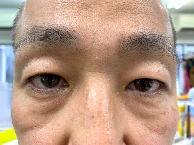 【実録】右目が急に見えにくくなってきた → 2カ月放置して眼科へ行ったらギリギリのところだった話