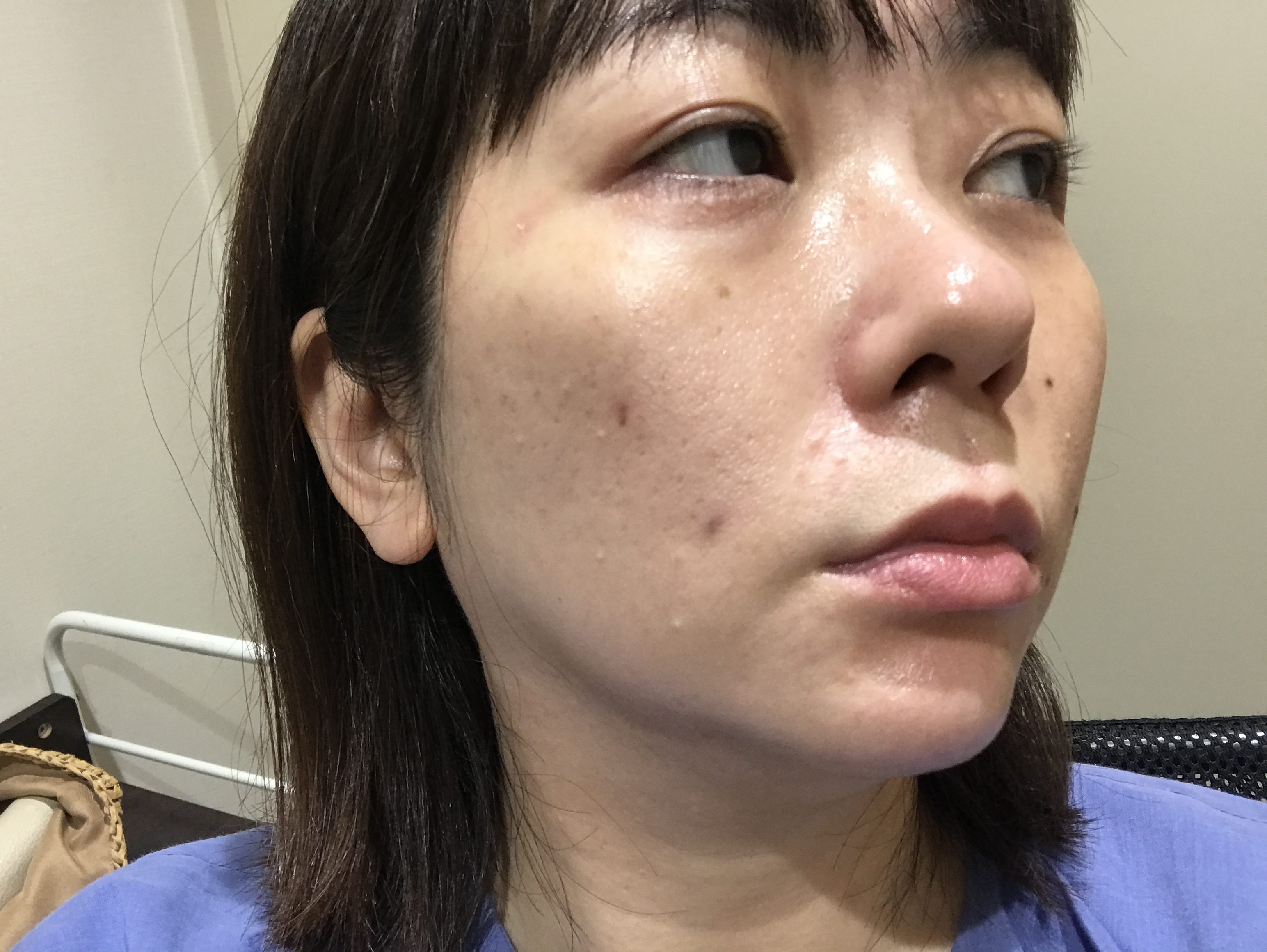 美肌治療の初心者にピッタリか…「フォトフェイシャル」を受けたらシミ