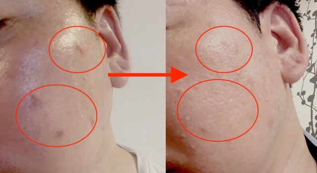 【実録】アラフィフの顔イボを皮膚科で治療したらどれくらいで取れるのか? 経過や費用などのリアルを赤裸々にお伝えしよう 【実録】アラフィフの顔イボを皮膚科で治療したらどれくらいで取れるのか? 経過や費用などのリアルを赤裸々にお伝えしよう