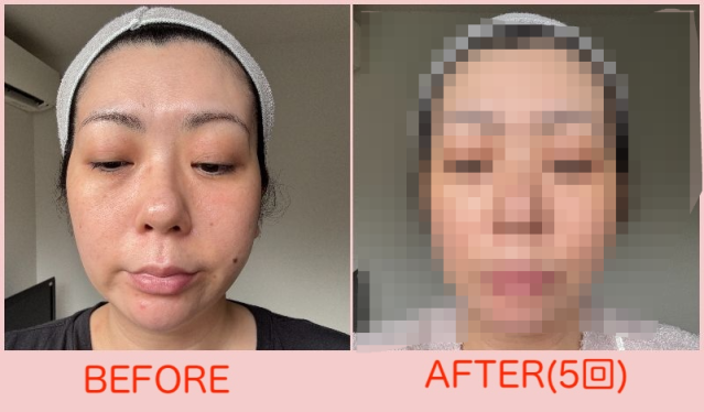 約10万円かけて「ピコダブル」を5回受けた結果 → 毛穴と美白の効果は?【40代女子の自腹レボリューション第22回】 約10万円かけて「ピコダブル」を5回受けた結果 → 毛穴と美白の効果は?【40代女子の自腹レボリューション第22回】