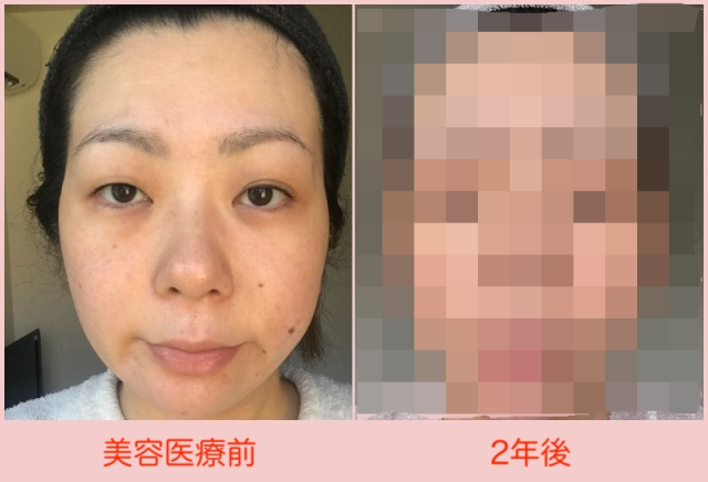 【検証2年】美容医療に約30万かけて肌はどう変わったかのビフォーアフター公開！【40代女子の自腹レボリューション第23回】