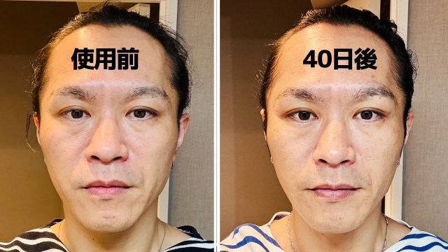 40日続けた結果…クチトレでほうれい線は消えたのか 40日続けた結果…クチトレでほうれい線は消えたのか